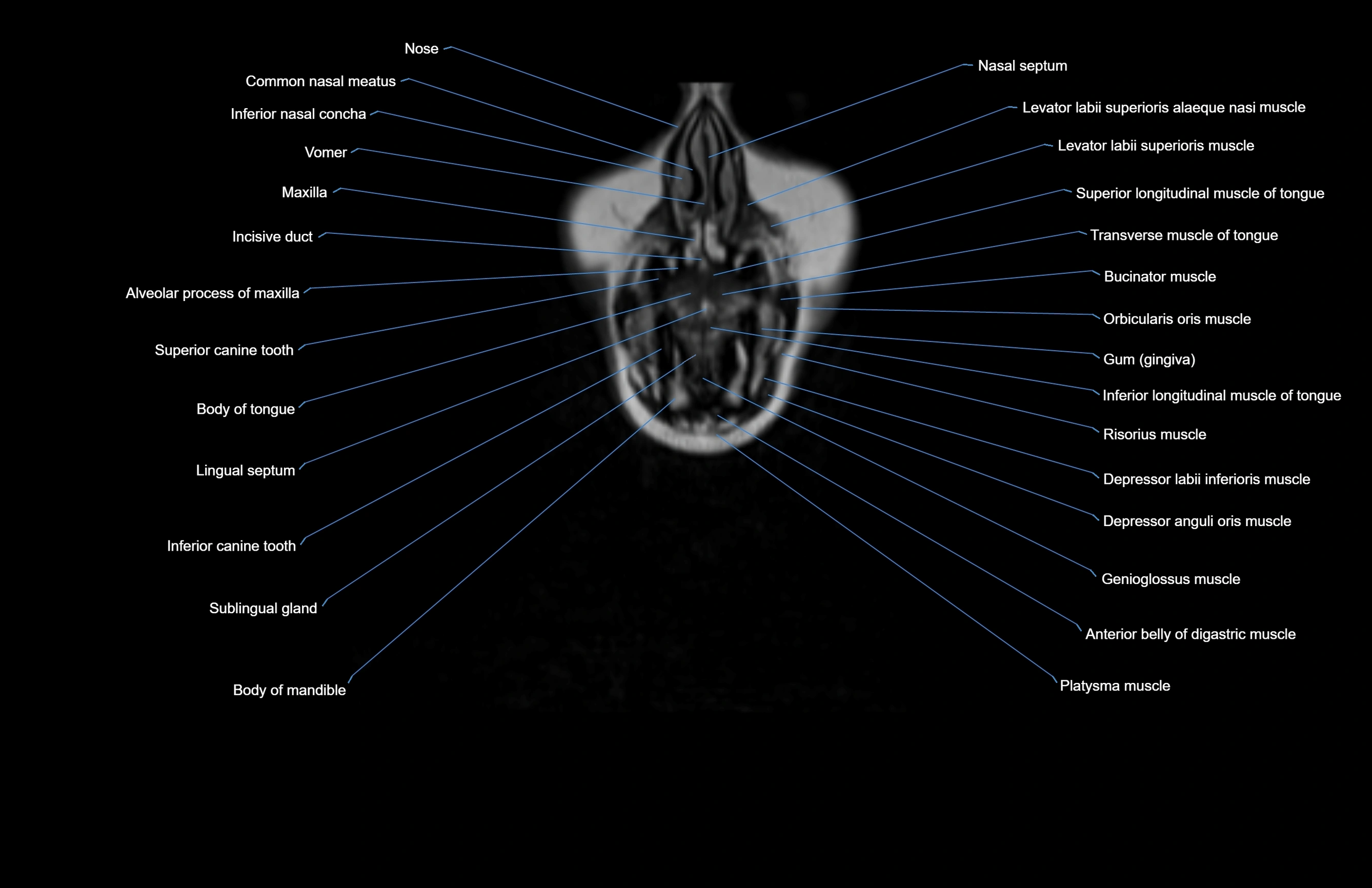 Neck coronal cross sectional MRI anatomy 3T MRI  image-img-00001-00073.webp